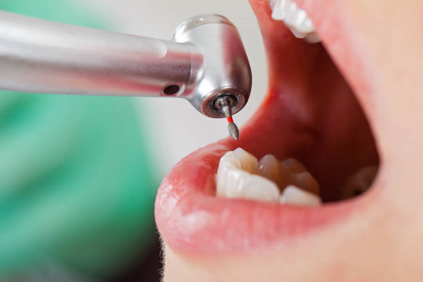 Best Emergency Dentist for Lost Fillings or Crowns in Belton, TX